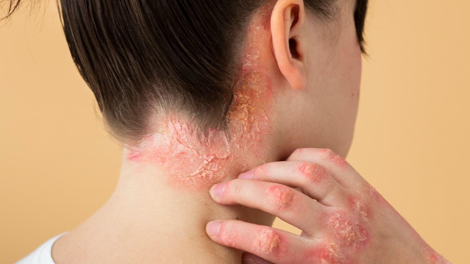 Imagem que ilustra a doença: O que é Artrite Psoriásica?