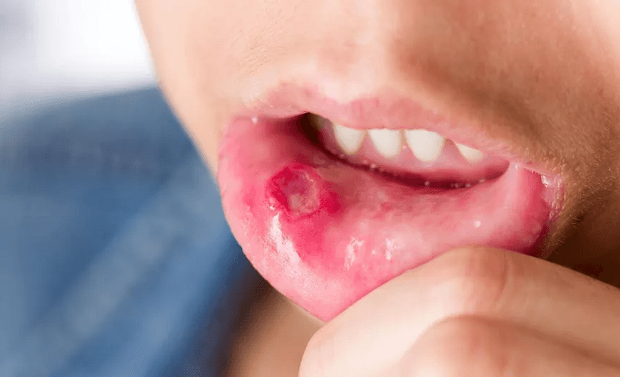 Imagem que ilustra a doença: Síndrome de Behçet